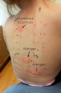 Отрицательный результат фадиатопа говорит об отсутствии аллергии?