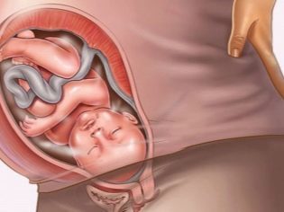 Отслойка плаценты на ранних и поздних сроках беременности: факторы риска, сопутствующие симптомы, врачебные действия и возможные последствия