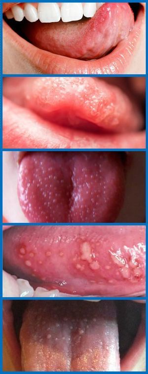 Ожог языка кипятком: степени повреждений, методы лечения, запрещенные действия и профилактика
