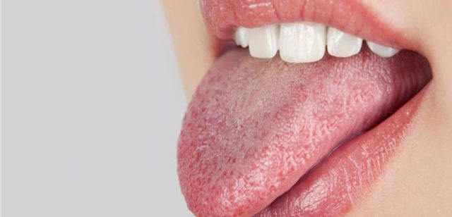 Ожог языка кипятком: степени повреждений, методы лечения, запрещенные действия и профилактика