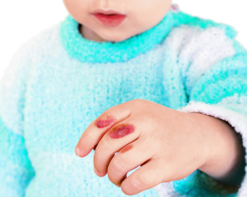 Ожоги у детей: степени повреждений, первая помощь, особенности лечения и меры профилактики
