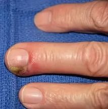Панариций на пальце руки, ноги: что это такое, характерные симптомы, методы лечения и профилактика заболевания
