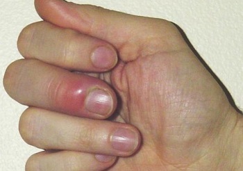 Панариций на пальце руки, ноги: что это такое, характерные симптомы, методы лечения и профилактика заболевания