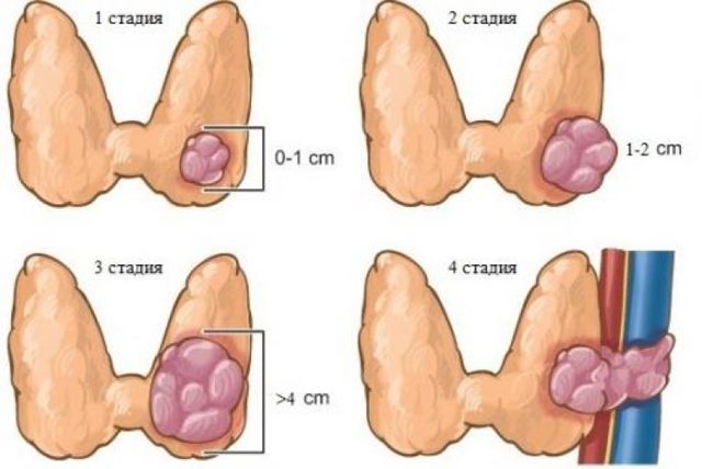 Папиллярный рак щитовидки: причины возникновения, клиническая картина, тактика лечения и прогноз
