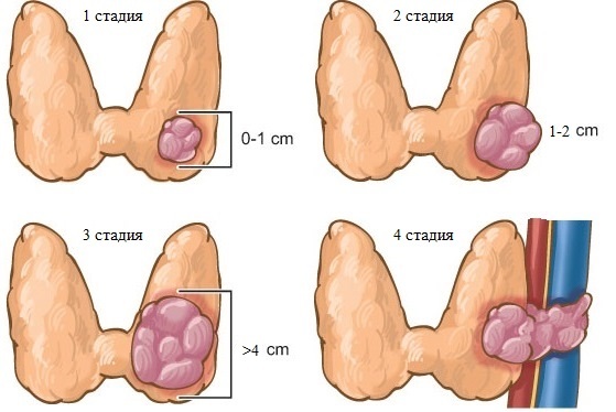 Папиллярный рак щитовидки: причины возникновения, клиническая картина, тактика лечения и прогноз