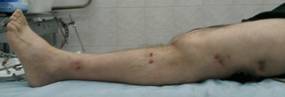 Парапротезная инфекция тазобедренного, коленного сустава: виды, поверхностные и глубокие поражения, методы диагностики, способы лечения