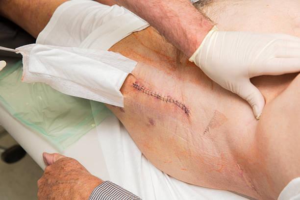 Парапротезная инфекция тазобедренного, коленного сустава: виды, поверхностные и глубокие поражения, методы диагностики, способы лечения