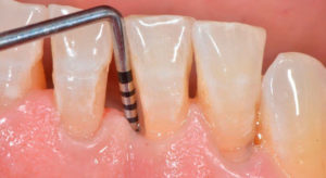 Патологическая подвижность зубов у взрослых – что делать?