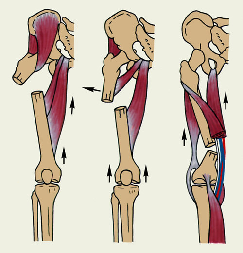 Патологический перелом бедренной кости: провоцирующие факторы, клиническая картина, методы обследования и лечения