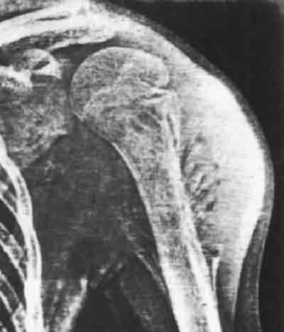 Патологический перелом плечевой кости, перелом при метастазах: симптомы, лечение