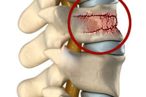 Патологический перелом плечевой кости, перелом при метастазах: симптомы, лечение