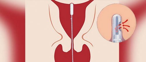 Пайпель-биопсия эндометрия с гистологическим исследованием: показания и ограничения, подготовка к процедуре, порядок проведения