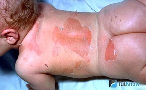 Пеленочный дерматит у детей: причины возникновения, характерные симптомы с подробными фото, методы лечения