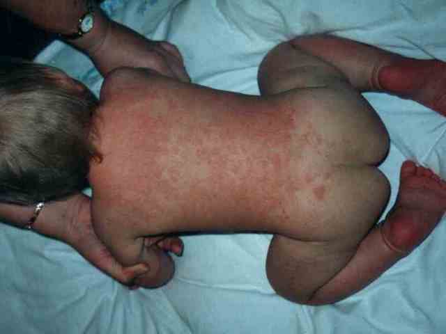 Пеленочный дерматит у детей: причины возникновения, характерные симптомы с подробными фото, методы лечения