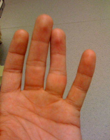 Перелом фаланги пальцев кисти руки: виды травм, симптомы, диагностика и лечение