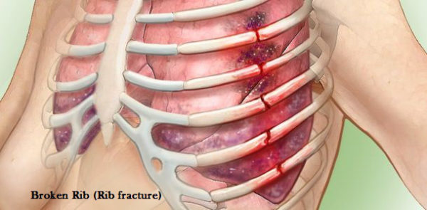 Перелом грудины: виды повреждений, сопутствующие симптомы, тактика лечения, период реабилитации