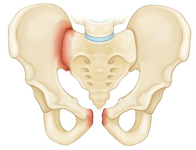Перелом костей таза: виды повреждений, неотложная помощь, методы терапии и реабилитации