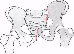 Перелом костей таза: виды повреждений, неотложная помощь, методы терапии и реабилитации
