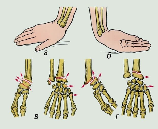 Перелом лучевой кости в типичном месте без смещения и со смешением, как разработать руку