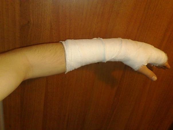 Перелом лучевой кости в типичном месте без смещения и со смешением, как разработать руку