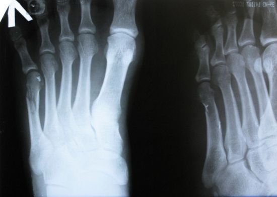 Перелом плюсневой кости стопы: факторы риска, клинические проявления, варианты лечения и сроки восстановления
