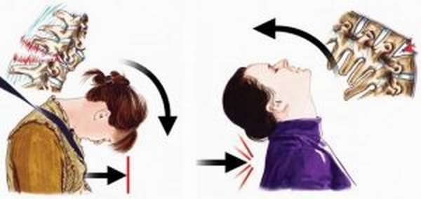Перелом шейного отдела позвоночника: характерные признаки, неотложная помощь при повреждении спинного мозга, методы лечения