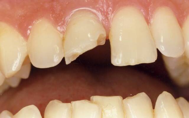 Перелом зуба: классификация травм, характерные признаки, методы обследования и лечения
