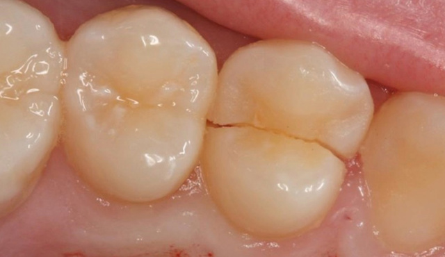 Перелом зуба: классификация травм, характерные признаки, методы обследования и лечения