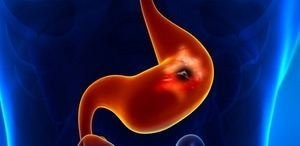 Перфорация желудка: стадии развития, характерные симптомы, способы лечения и возможные последствия