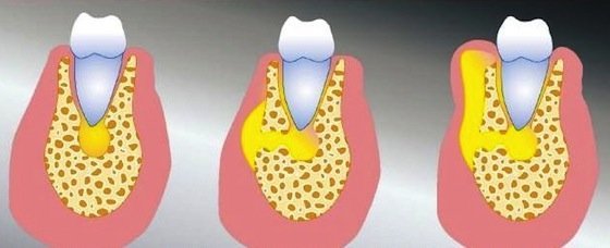 Периостит зуба на нижней и верхней челюсти, флюс на десне: симптомы, лечение