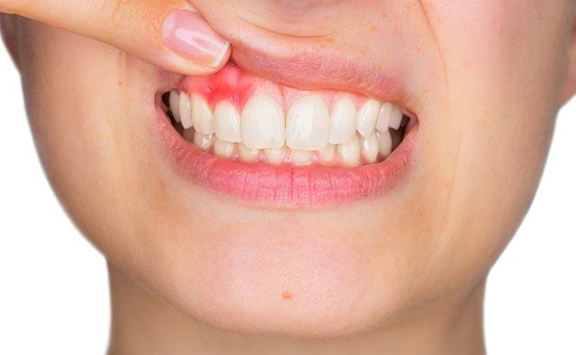 Периостит зуба на нижней и верхней челюсти, флюс на десне: симптомы, лечение