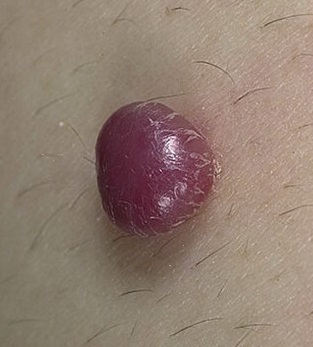 Пиогенная гранулема кожи: предрасполагающие факторы, клинические признаки, диагностика и тактика лечения