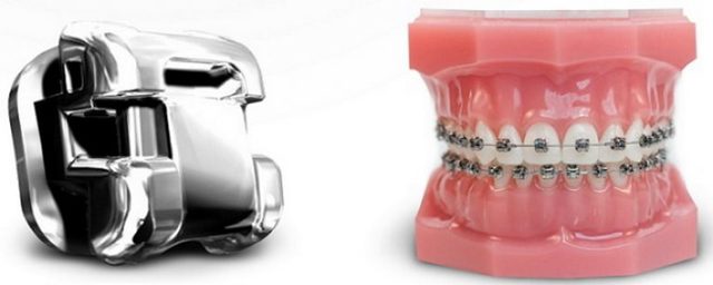 Пластина ребенку для выравнивания зубов, ортодонтические пластины для исправления прикуса