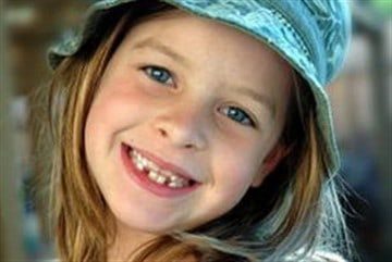 Пластина ребенку для выравнивания зубов, ортодонтические пластины для исправления прикуса