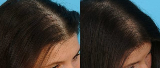 Плазмотерапия для лица и для волос: что это такое, преимущества и особенности процедуры, фото до и после