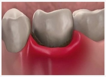 Пломбирование зубных каналов: особенности процедуры, возможные осложнения, методы снятия боли