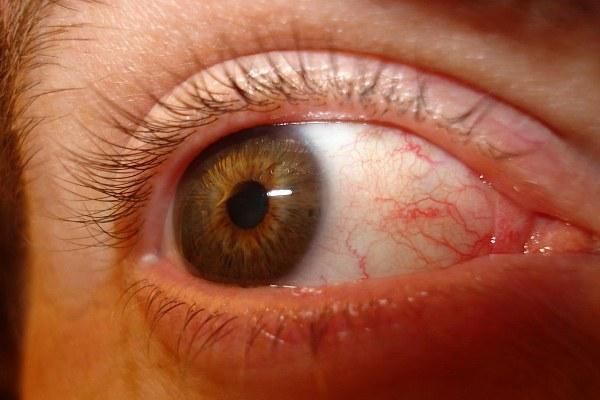 Почему болят глаза и возникает чувство усталости?