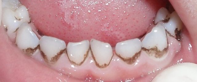 Почему потемнели зубы у ребенка: различные причины, что делать, когда эмаль изменила цвет после приема антибиотиков