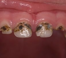 Почему потемнели зубы у ребенка: различные причины, что делать, когда эмаль изменила цвет после приема антибиотиков