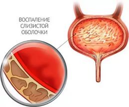 Почему появляется кровь в моче у женщин?