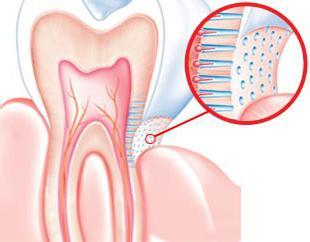 Почему развивается повышенная чувствительность зубов, и какие методы лечения применяются для ее снижения?