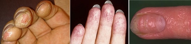 Почему сушат подушечки пальцев рук и что с этим делать?