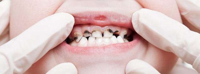 Почему темнеют зубы у взрослых: причины потемнения и методы отбеливания эмали