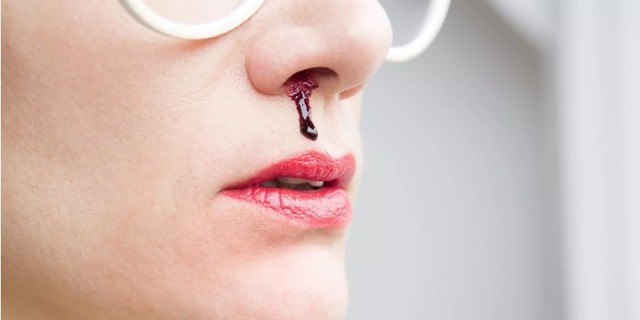Почему возникает носовое кровотечение и что делать: первая помощь