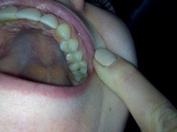 Почему выпадают пломбы из зубов, что делать, если плохо поставили пломбу