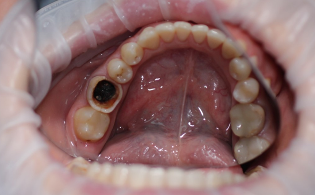 Почему выпадают пломбы из зубов, что делать, если плохо поставили пломбу