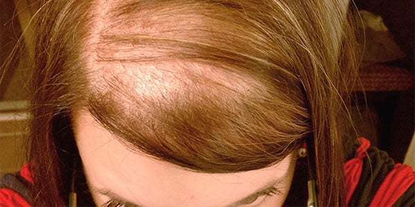 Почему выпадают волосы у женщины в молодом возрасте: главные причины и методы устранения проблемы