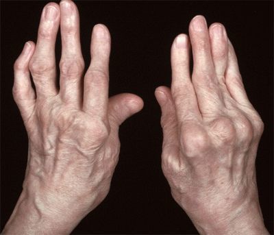 Подагрический артрит – симптомы, принципы медикаментозного и народного лечения, список вредных и полезных продуктов при болезни