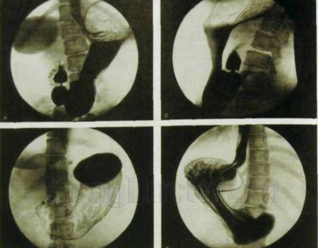 Подготовка к ре рентгену желудка с барием и контрастом: что показывает процедура и ФГДС