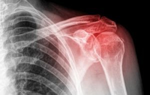 Подвывих плечевого сустава: причины и классификация повреждения, характерные симптомы, тактика лечения